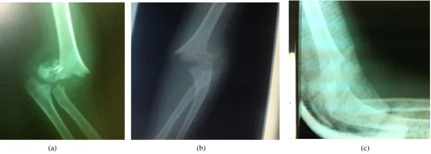 Figure 1. (a) shows AP and lateral X ray of Gartland type III fracture shows type III