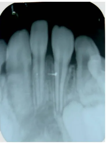 Figure 2. Intraoral periapical radiograph showing the conical shaped mesiodens with complete root formation without any evidence of pathologic periapical changes
