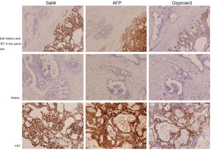 Figure 2. The epithelial tumor markers EMA, CK7, CA125, and PAX8 were positive in the adenocarcinoma compo-nents but completely negative in YST.