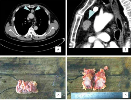 Figure 1. A. Chest CT showed a mass of soft tissue density in the anterior mediastinum