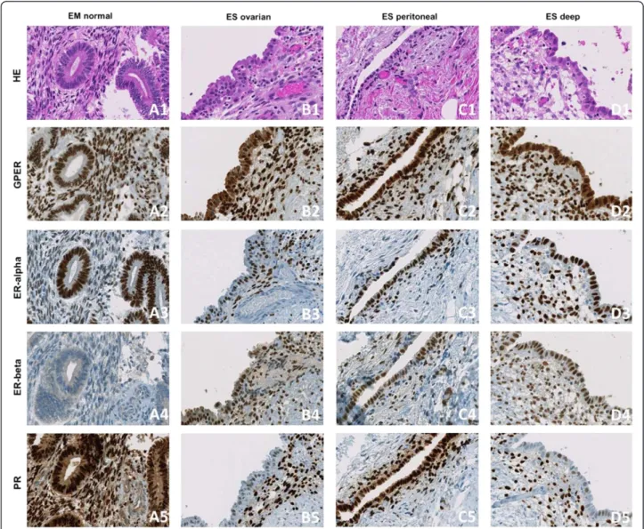 Figure 2 Representative histological tissue samples. Representative tissue samples of a normal endometrium (EM normal) microarray core (A1 – A5), an ovarian endometriosis (ES ovarian) tissue core (B1 – B5), a peritoneal endometriosis (ES peritoneal) tissue