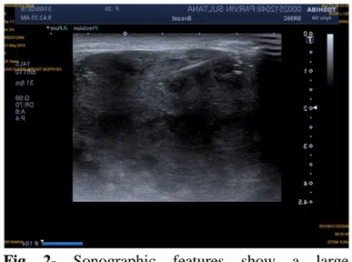 Fig  2-  Sonographic  features  show  a  large 