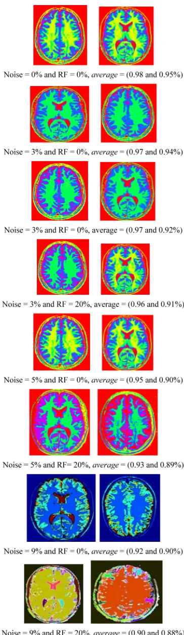 Table 1. The segmentation average of slices (T1-weigthed and T2-weighted MRI) with different situations of noise level and intensity non-uniformity (RF)