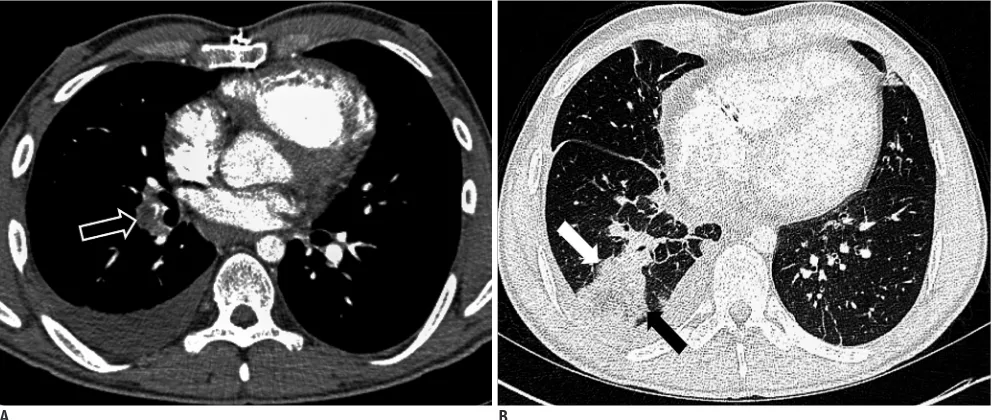 Fig. 8. 16-year-old girl with oral contraceptive medication and chronic pulmonary embolism