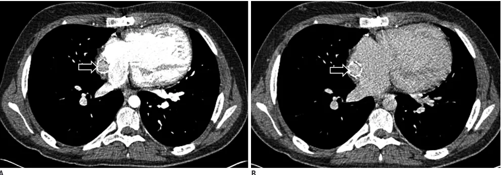 Fig. 2. 16-year-old boy with history of double outlet right ventricle status post Fontan procedure who presented with shortness of breath