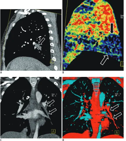 Fig. 3. Acute pulmonary embolism on dual-energy computed tomography. A. Sagittal reformatted image demonstrating occlusive pulmonary embolism (arrow) in posterior basal branch of right pulmonary artery