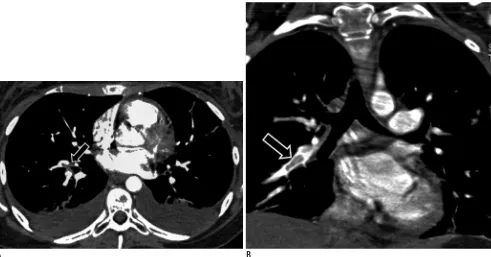 Fig. 4. 15-year-old girl with oral contraceptive medication who presented with acute shortness of breath and chest pain