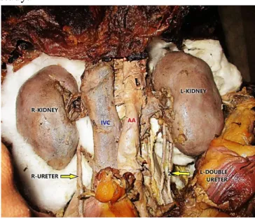 Fig 1: Duplicated left ureter Table 1: Proportion of duplicated ureter 