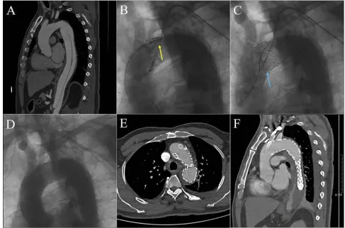 Figure 1 Chimney stent was deployed as a bailout to reconstruct the LCCA. TBAD was conﬁrmed by preoperative CTA (A)