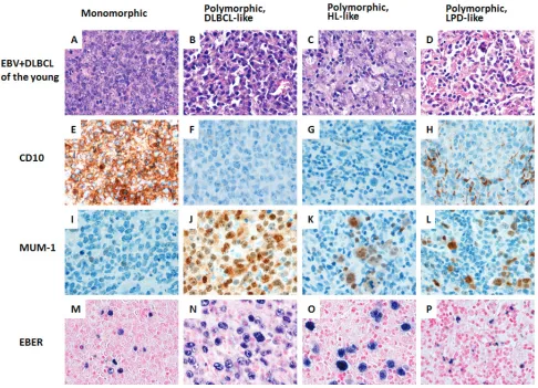 Figure 2: A spectrum of morphologic variants and immunophenotypic profiling in EBV-positive diffuse large B-cell lymphoma of the younger patients