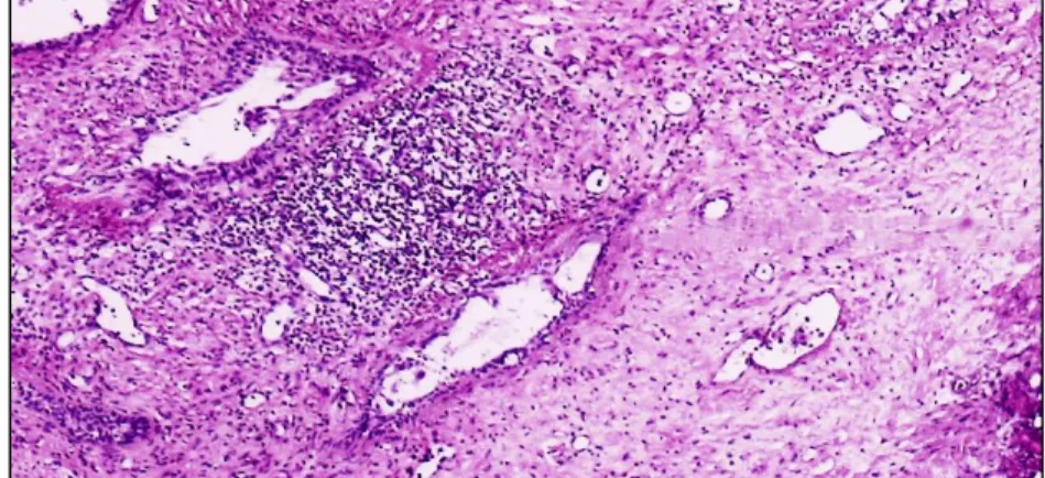 Figure 4. Microscopic features of prostatitis with chronic inflammatory cells in the stroma