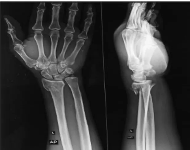 Figure 1: Pre-op AP and lateral X-ray. 