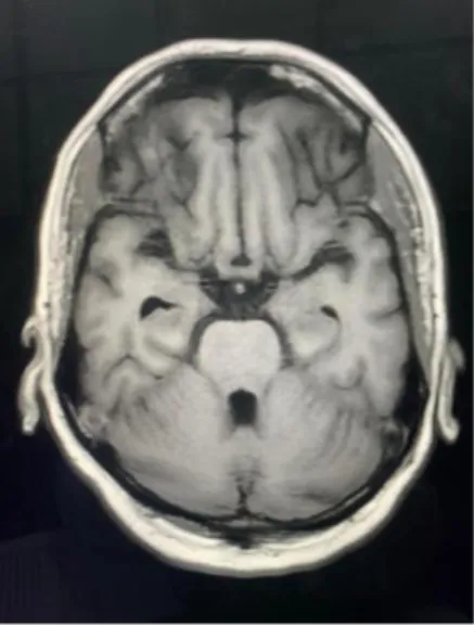 Figure 7: Enhancement of meninges along pons and  4 th  ventricle. 