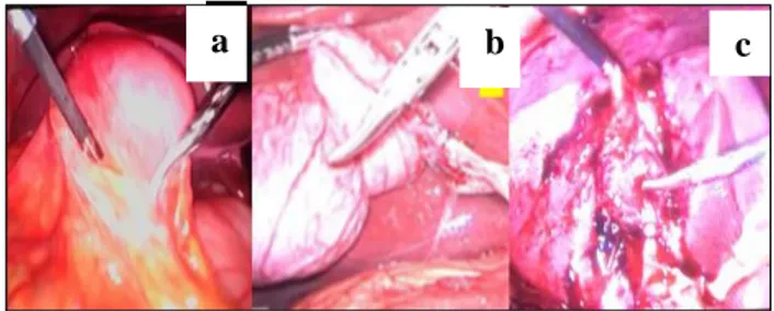 Figure 1: (a-c) Steps in modified 3 port          laparoscopic cholecystectomy. 