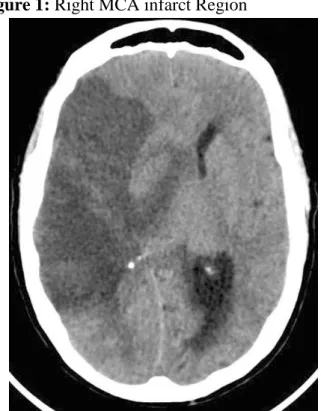 Figure 1: Right MCA infarct Region 