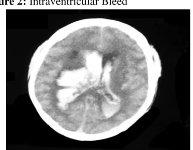 Figure 2: Intraventricular Bleed 