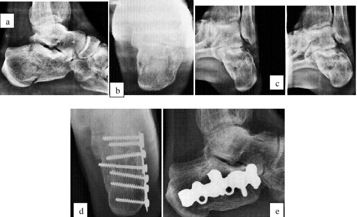 Figure 3:- (a)Lateral (b)Harris axial (c)Brodens view radiographs of intra-articular calcaneum fracture