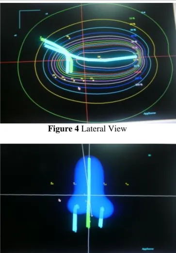 Figure  1  Orthogonal  X-Ray  Based  ICBT  –  AP 