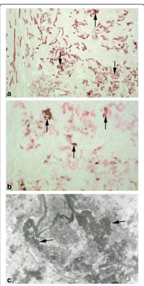 Fig. 3 Characteristic histological features of PXE in skin biopsies. aOrcein staining: the elastic fibers of the dermis are fragmented andthickened