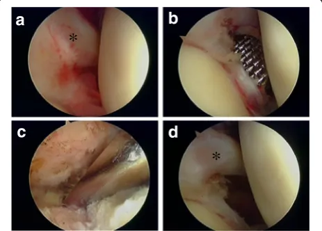 Fig. 1 Arthroscopic classification based on the severity of adhesion of LHB and CH ligament.by obtuse rod