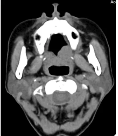 Figure 1. Neck CT with contrast was performed. An approximately 3.0-cm mass (white arrow) in the hard palate on the left side was noted