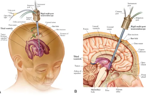 Fig. 2.ETV procedure. Oblique view (A) demonstrating typical location of the burr hole and