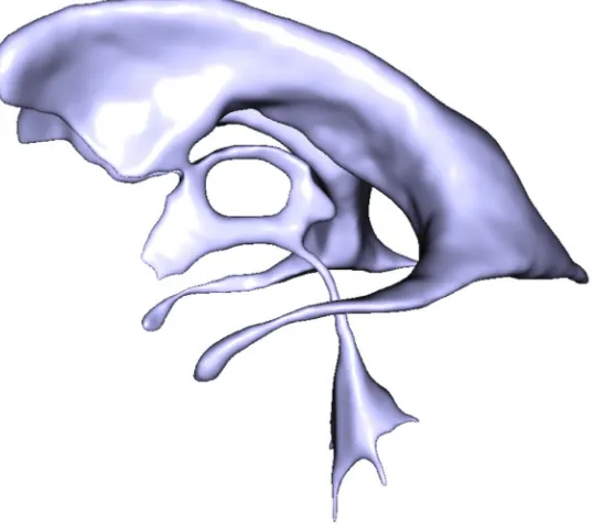 Fig. 4.Geometric models of the VS of healthy (A) and hydrocephalic (B) subjects. The models