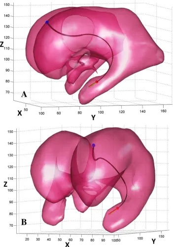 Fig. 7.Example 2 - the objective is to navigate inside the VS of a hydrocephalic ventricle and to