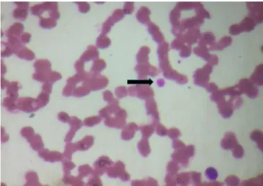 Figure  2-  Peripheral  smear  showing  severe 