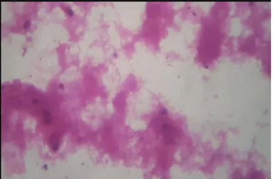 FIG  III  Photomicrograph  showing  carcinoid 