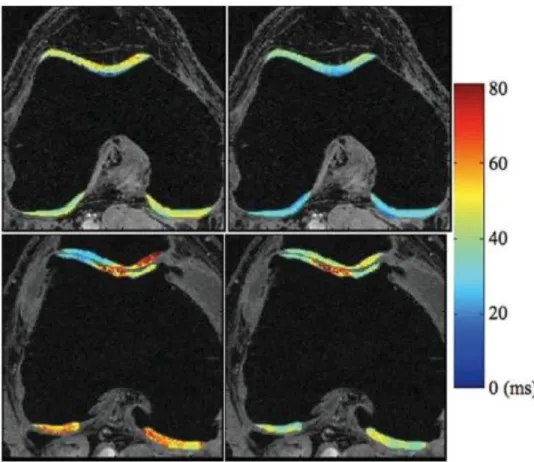 Figure 4. T1 (left) and T2 (right) of a healthy control (upper row) and osteoarthritic individual  (lower row)