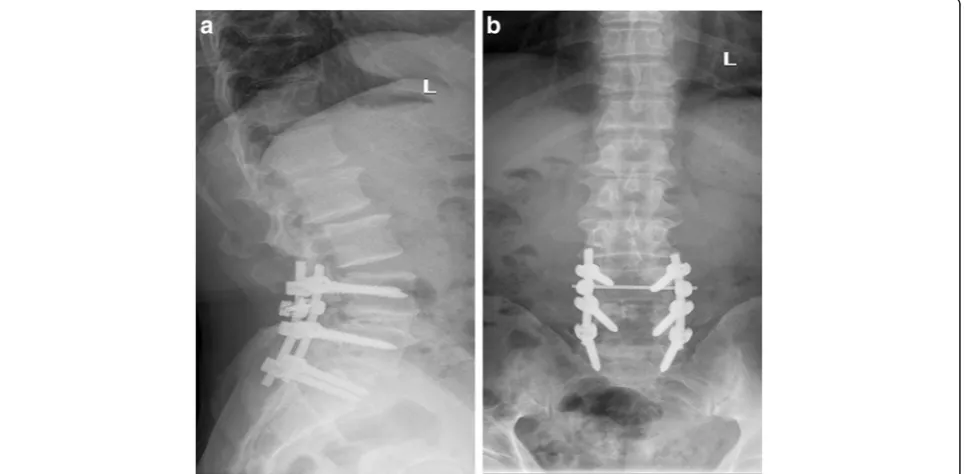 Fig. 4 f, g Postoperative lumbar spine showing L4–L5 correction with restoration of the physiological curvature of the spine