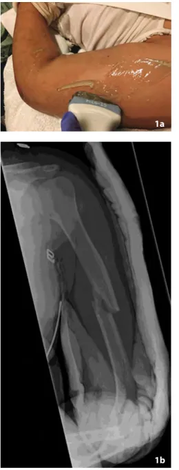 Figure 1. Intact radial nerve in 18-year-old female with humer- humer-al shaft fracture and radihumer-al nerve phumer-alsy status post humer-all-terrain  vehicle (ATV) accident (Patient 4)