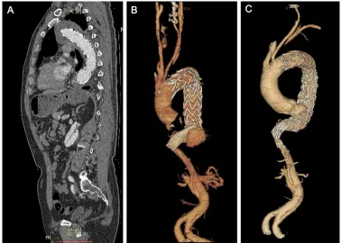 Figure 2 (A) Vertical plane of the patient after the first TEVAR. (B) 3D aorta reconstruction of the patient before the second intervention