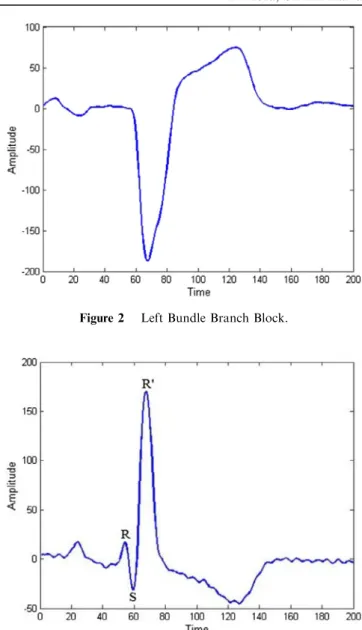Figure 1 Normal beat.