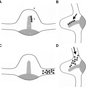 Figure 1 Theories of posterior semicircular canal stimulation in BPPv.Notes: (A) Cupulolithiasis: adherence of debris to the cupula making it gravity sensitive (1