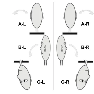 Figure 2 The Dix-Hallpike test, for the left (L) ear on the left panel and for the right (R) ear on the right panel.Notes: (A) Initial sitting position