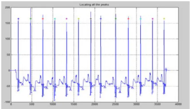 Figure 3.2: Testing Signal #103(Normal signal) 