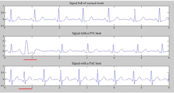 Figure 3.  The beats of 6 seconds ECG record (the abnormal beats are  underlined). The vertical axis represents the voltage of heartbeat electricity 