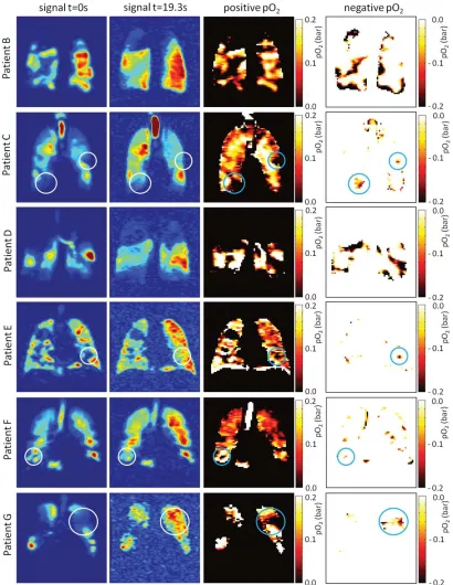 FIG. 5. Source images and calculated pO2 maps from 9 COPD patients. Normalized signal at the first imaging time-point (column 1)and last imaging time-point (column 2)