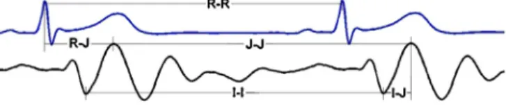 Fig. 2. Time intervals from one cardiac cycle to another in the ECG (top) and the BCG (bottom)