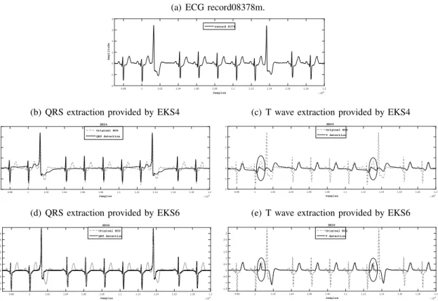Fig. 2. QRS complex and T-wave estimates provided by EKS6 and EKS4, for record 08378m from the MIT-BIH Atrial Fibrilation Database (afdb).