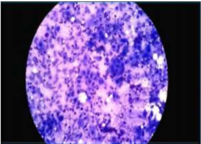 Table 3: Distribution of neoplastic salivary                         gland lesions. Lesions  No