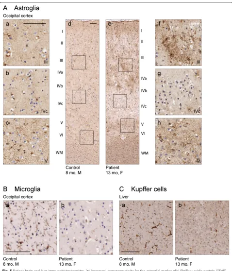 Fig. 5 Patient brain and liver immunohistochemistry. (a) Increased immunoreactivity for the astroglial marker glial fibrillary acidic protein (GFAP)and change in the morphology of astroglial cells, two classical signs for astroglial activation, can be seen