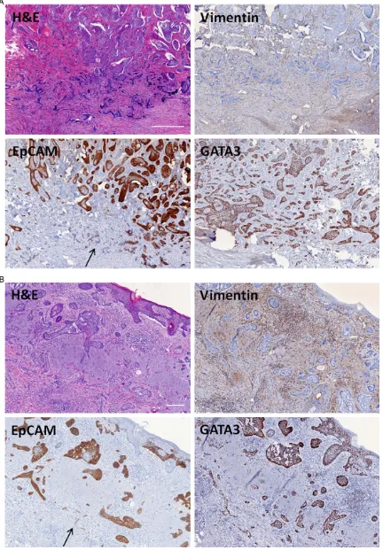 Figure 2. Histopathological examination demonstrating the immunohistochemical features of two cases (A, B) of infiltrating BCC
