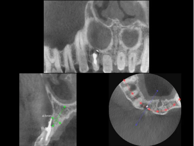 Fig 3.2  Pre-extraction Clinical Photo  Fig. 3.3  Extraction Socket      
