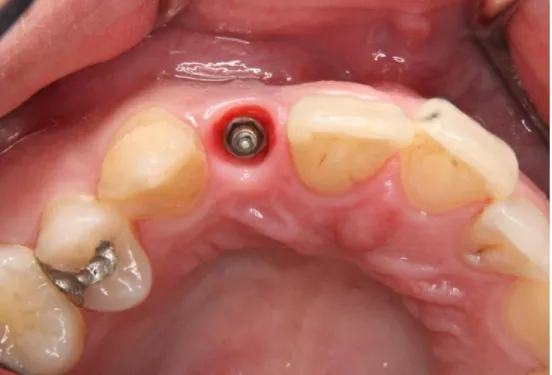 Fig 3.7  Provisional Restoration in Place 