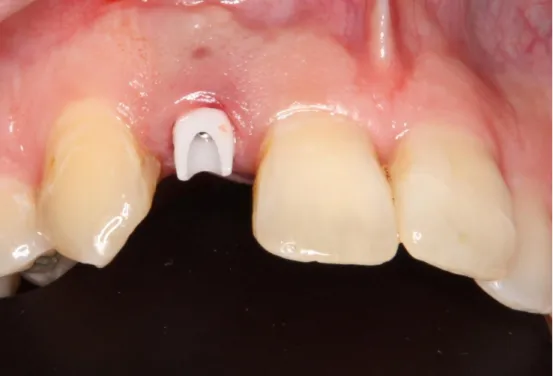 Fig 3.9  All-Ceramic Definitive Restoration 