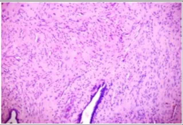 Figure 3: Malignant Tumor-marked stromal  overgrowth, marked nuclear atypia and increased 