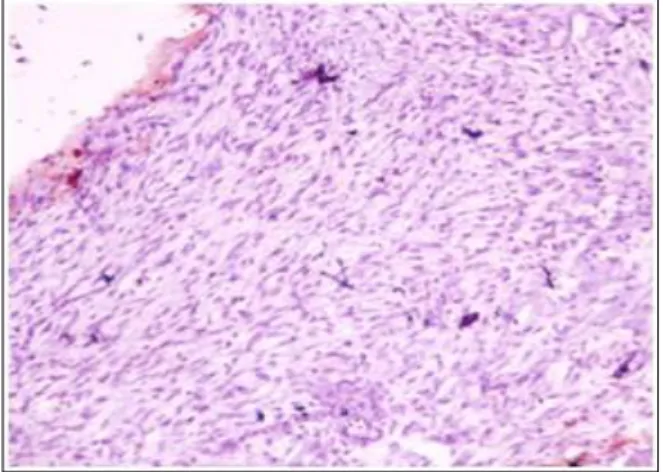 Figure 6: Borderline phyllodes tumor- Negative for  CD10 immunostaining in tumor cells 100x